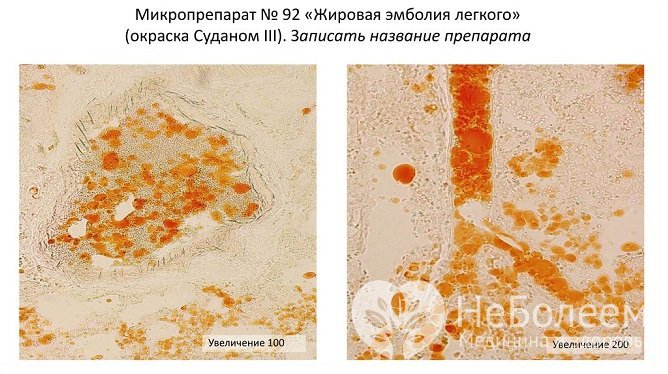 Диагностика жировой эмболии легких