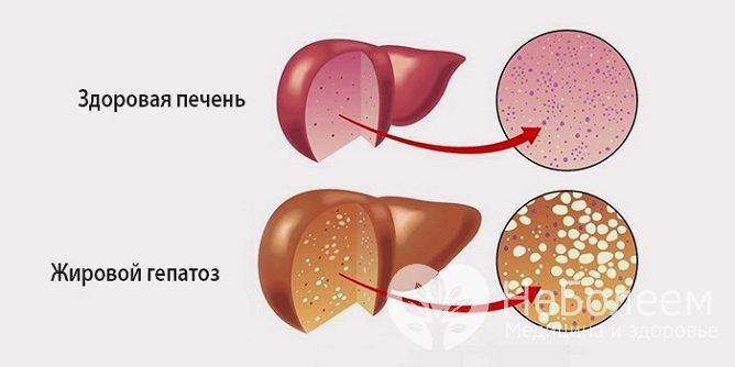 Что такое жировой гепатоз?