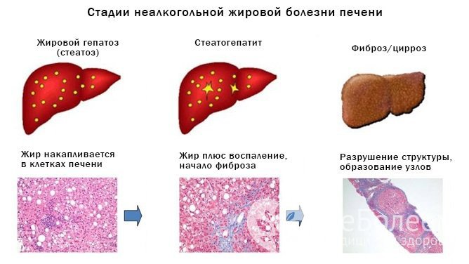 Возможные последствия и осложнения жирового гепатоза