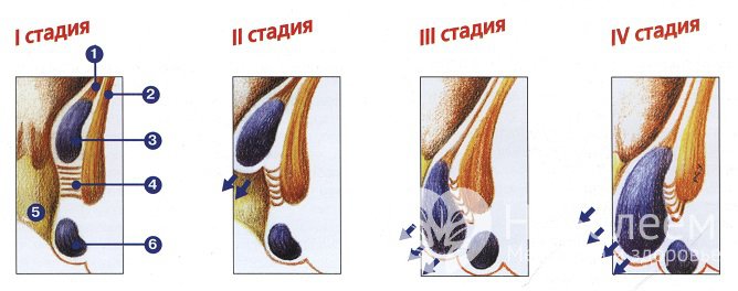 Четвертая стадия геморроя не может быть вылечена консервативными методами, требуется хирургическое вмешательство