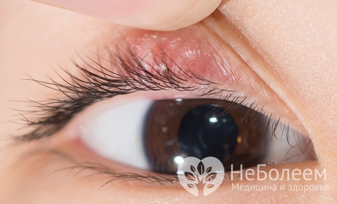 Частые ячмени – проблема, свидетельствующая о болезни глаз
