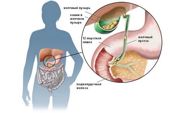 Желчнокаменная болезнь: эффективные домашние средства