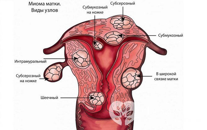 Миома матки: виды узлов