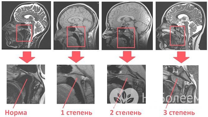 Аденоиды, постепенно разрастаясь, перекрывают носовые ходы