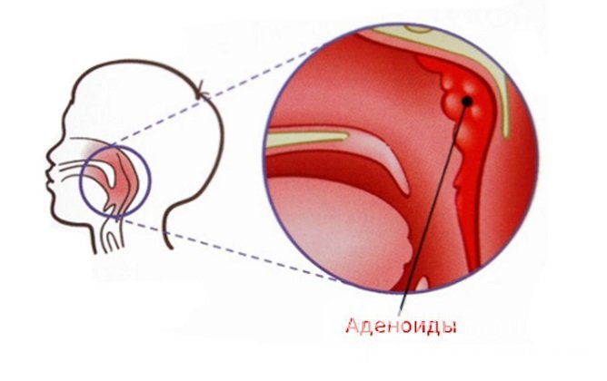 Аденоиды - одно из самых частых заболеваний детского возраста