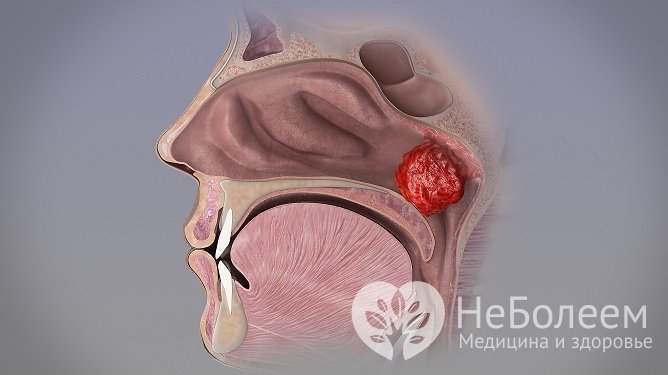 Гипертрофированная носоглоточная миндалина может полностью перекрывать просвет носовых ходов