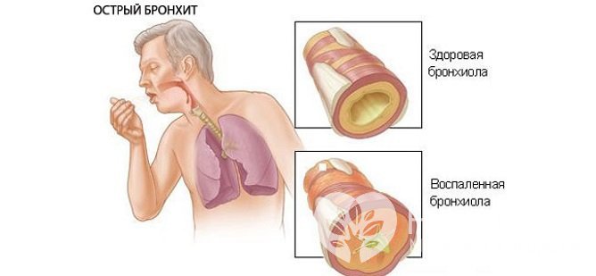 При остром бронхите выделяется незначительное количество мокроты