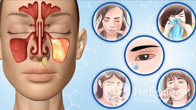 Гайморит характеризуется типичными симптомами – головной болью, обильными выделениями из носа, повышением температуры тела