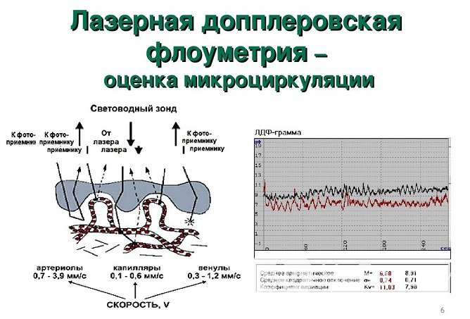 С целью оценки состояния микроциркуляции слизистой оболочки задней стенки глотки применяется лазерная допплеровская флоуметрия