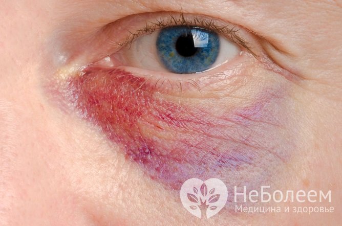 Бадяга от синяков под глазами: особенности применения, меры предосторожности