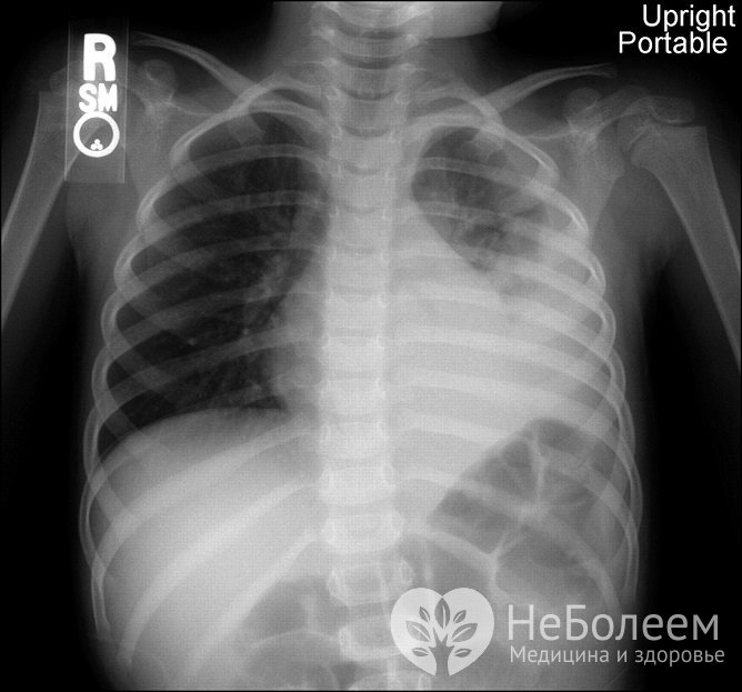 Для подтверждения диагноза проводится рентгенологическое исследование грудной клетки