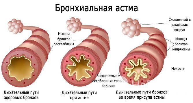 Астматические приступы провоцируются скоплением слизи в просветах бронхов и их спазмом