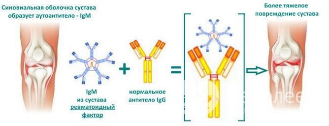 Ревматоидный фактор повышается при системных заболеваниях, протекающих с разрушением соединительной ткани