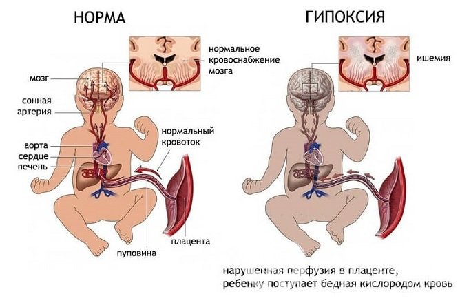 При длительном нарушении носового дыхания может развиться гипоксия плода