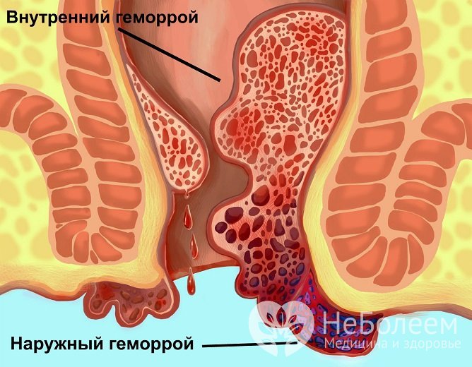 Наружные геморроидальные узлы обнаруживаются на ранних стадиях геморроя, а внутренние могут быть видимы только когда выпадают