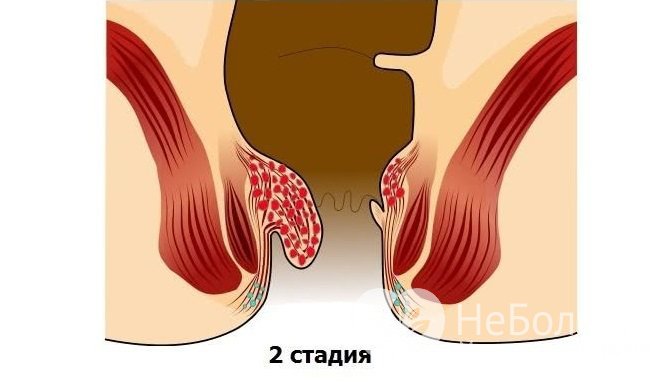 На данной стадии геморрой может быть излечен консервативными средствами