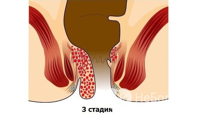 Геморрой 3 стадии характеризуется выпадением узлов при любой физической нагрузке, при этом узлы поддаются ручному вправлению