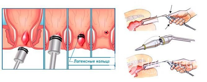 Латексное лигирование – малоинвазивный метод лечения геморроя, применяемый на 3 стадии