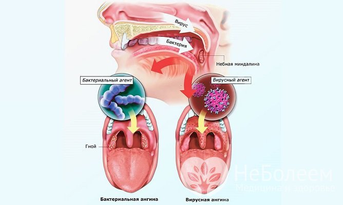 Симптомы вирусной и бактериальной ангины отличаются
