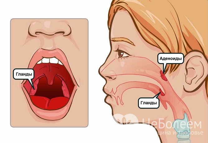Гнойная ангина, поражающая миндалины, может возникать как у детей, так и у взрослых