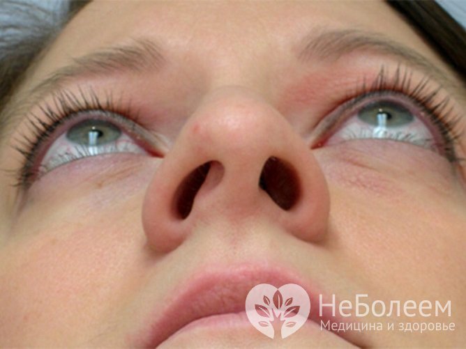 Одним из триггерных факторов развития патологии является искривление носовой перегородки