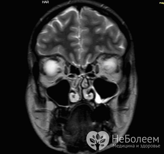 Для уточнения диагноза может быть назначена магнитно-резонансная томография гайморовых пазух