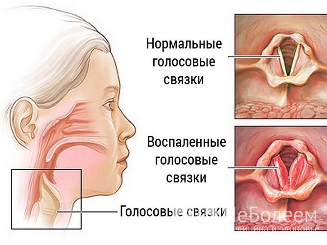 Нарушение голоса связано с воспалением гортани и голосовых связок