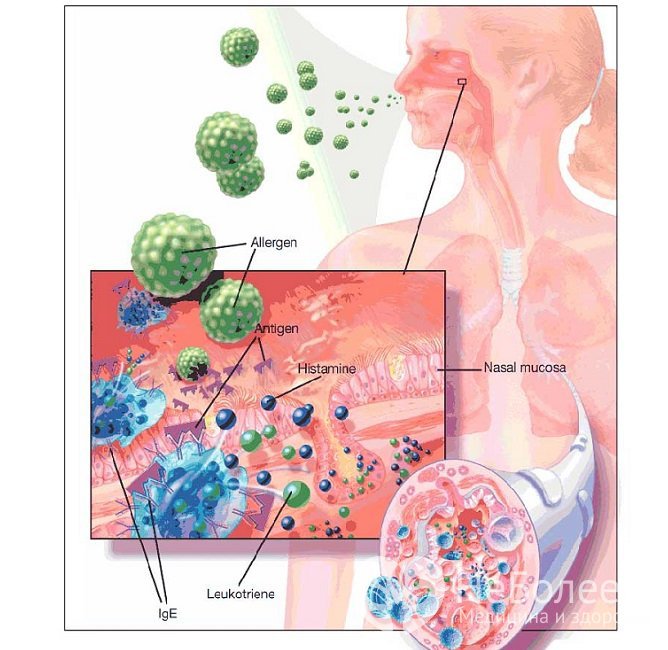 В основе аллергической формы ринита лежит специфическая IgE-зависимая реакция между аллергеном и тканевыми антителами