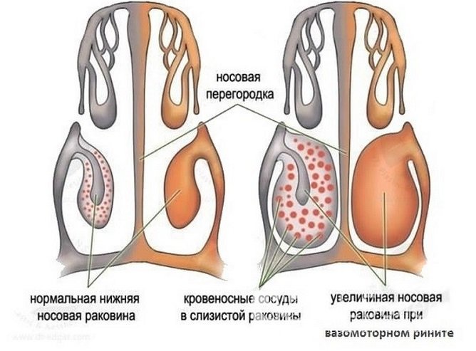 Для болезни характерно увеличение объема нижних носовых раковин