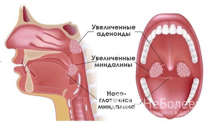 Один из факторов риска развития болезни – аденоидит