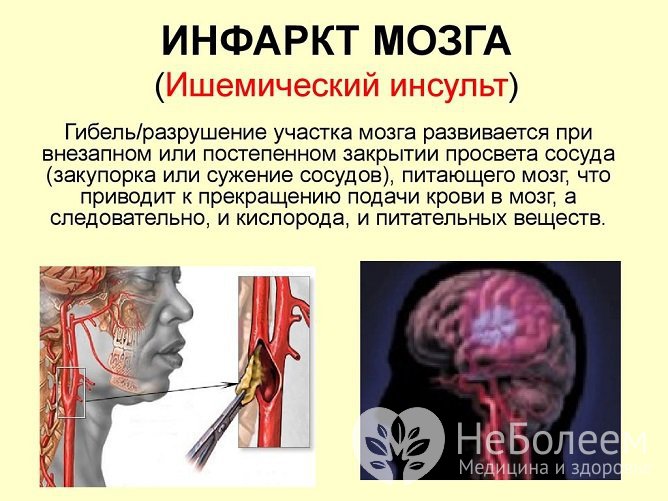 Другое название инфаркта мозга – ишемический инсульт