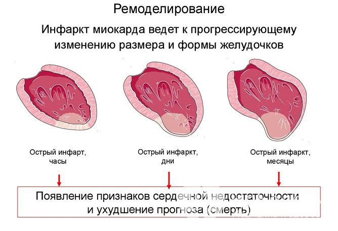 Инфаркт опасен развитием тяжелых осложнений