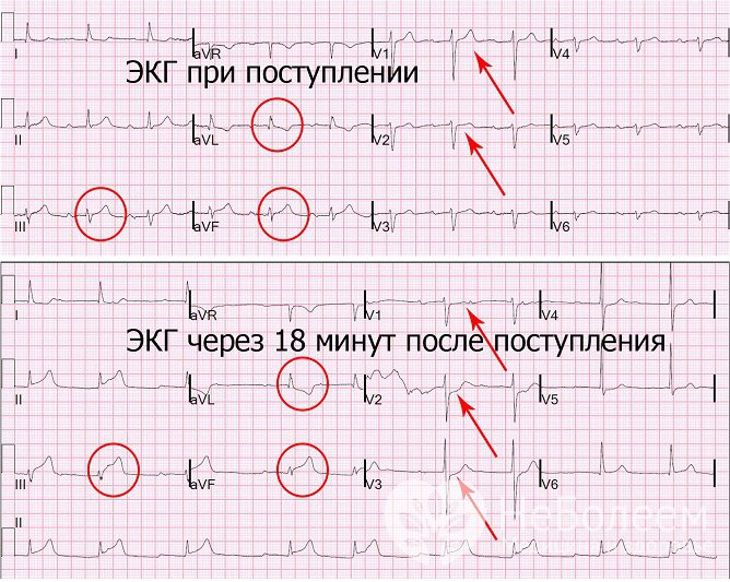 Характерные ЭКГ-признаки инфаркта миокарда обнаруживаются на всех его стадиях