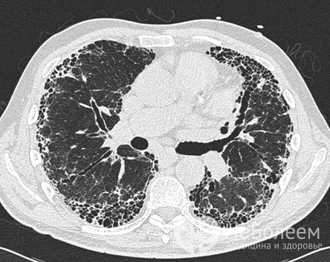 Для подтверждения диагноза проводится компьютерная томография легких высокого разрешения