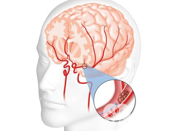 Ишемический инсульт вызывается блокированием кровотока в одной из мозговых артерий