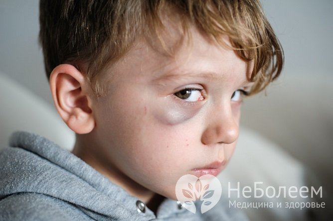 Как быстро убрать синяк: эффективные средства