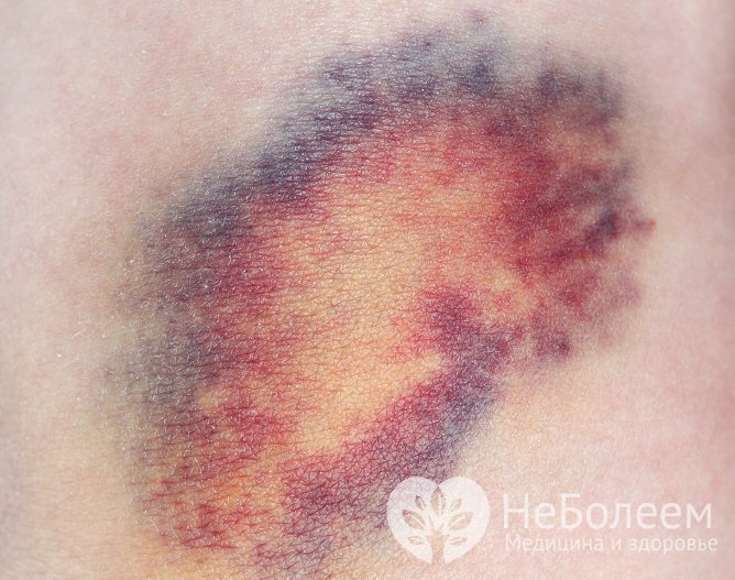 Подкожная гематома характеризуется болезненностью, припухлостью и изменением цвета области травмирования