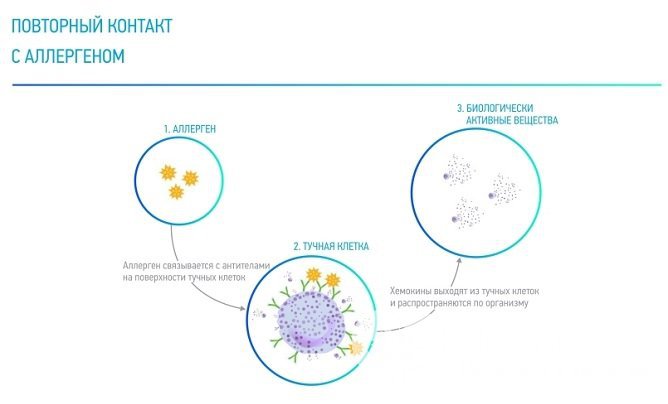 Механизм развития аллергического ринита обусловлен связыванием аллергена с антителами на поверхности тучных клеток