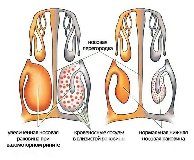 Лечение направлено на уменьшение кровенаполнения слизистой оболочки носа