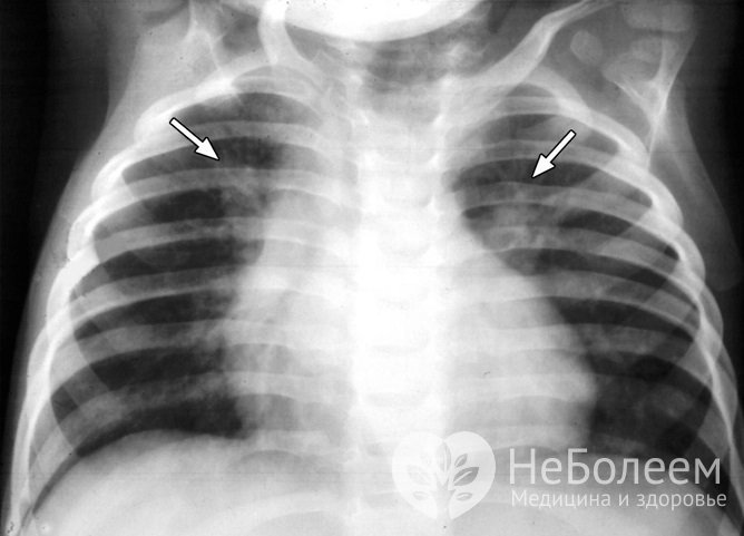 Точным методом, позволяющим отличить бронхит от пневмонии, является рентгенография