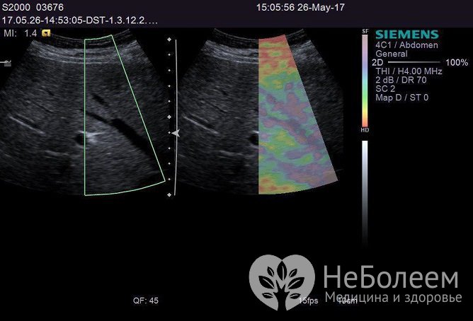 Эластография – современный метод ультразвуковой диагностики печени