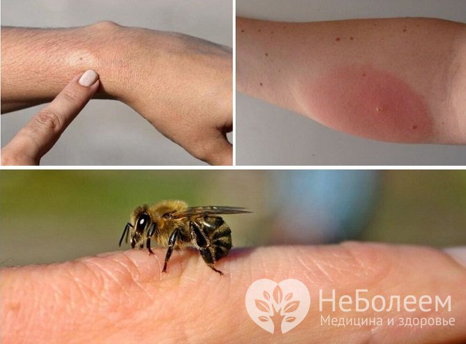 Появление большого отека после укуса пчелы говорит о развитии аллергической реакции
