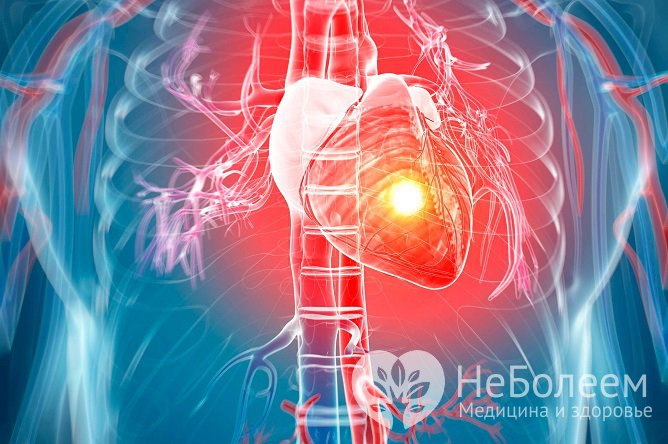 Повышенное давление является фактором риска развития инфаркта сердца