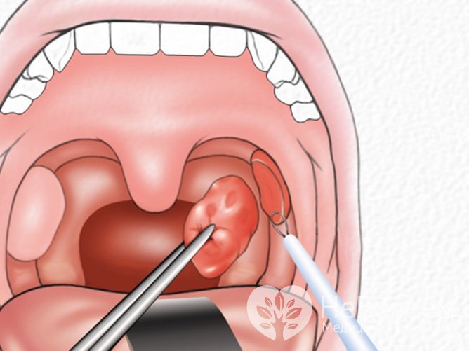 Удаление миндалин показано при появлении гнойно-воспалительных процессов