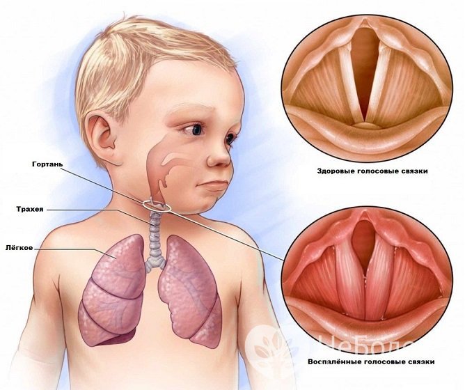 Развитию болезни способствуют анатомические особенности гортани у новорожденных
