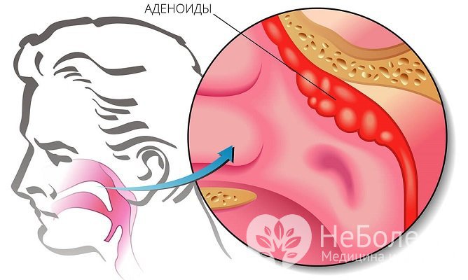 Аденоиды представляют собой разрастания глоточной миндалины
