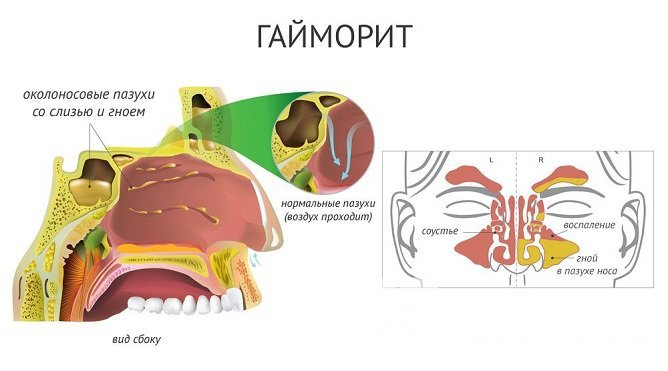 Применение антибактериальных аэрозолей позволяет подавить патогенную флору в гайморовых пазухах