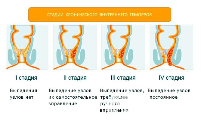 Лечение геморроя у мужчин в домашних условиях эффективно на начальных стадиях геморроя