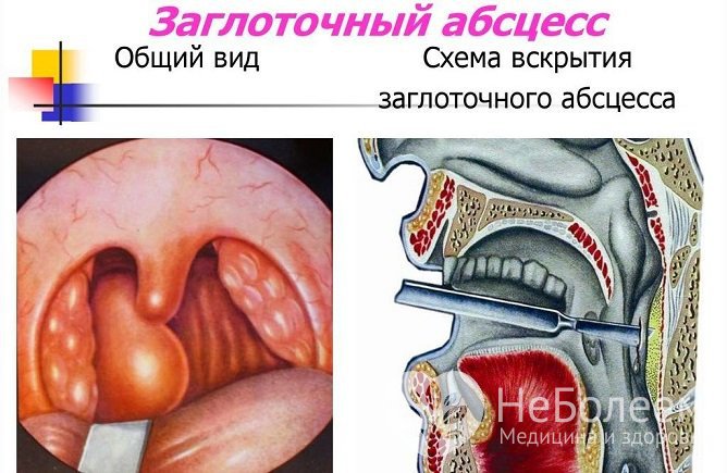 Заглоточный абсцесс – одно из частых осложнений ангины у детей