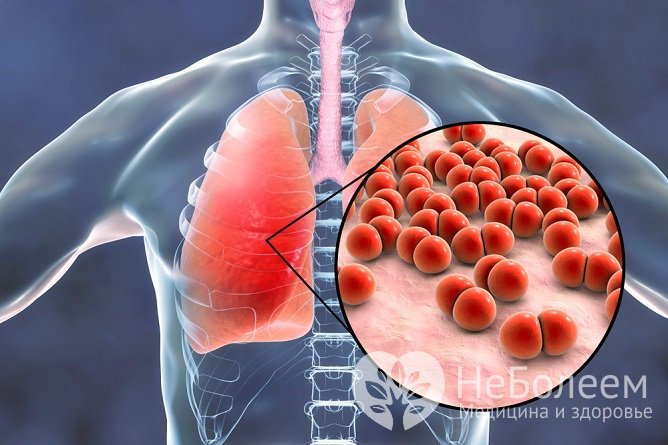 Чаще всего к развитию патологии приводят бактерии, в частности пневмококк